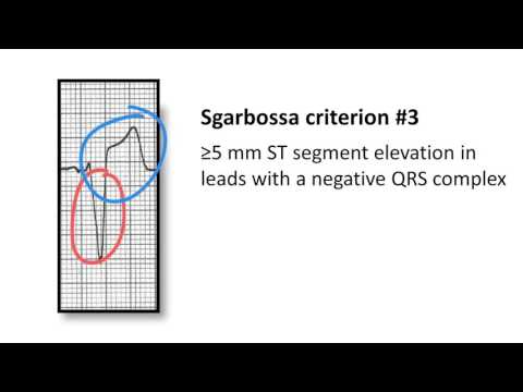 How to diagnose myocardial infarction in the presence of left bundle branch block (LBBB)