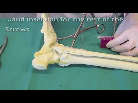 INION Freedom Plate   Ankle Fixation
