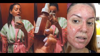 Pues Probemos El FAMOSO PEELING químico (THE ORDINARY) que ALISA TU PIEL en 10 min✅  PROCESO FULL