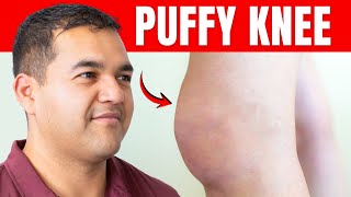Why is My Knee REALLY Puffy? | Physical Therapist Answers