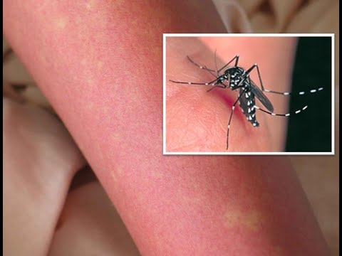 デング熱は将来ヨーロッパでも流行する