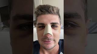 Getting a nose job at 23