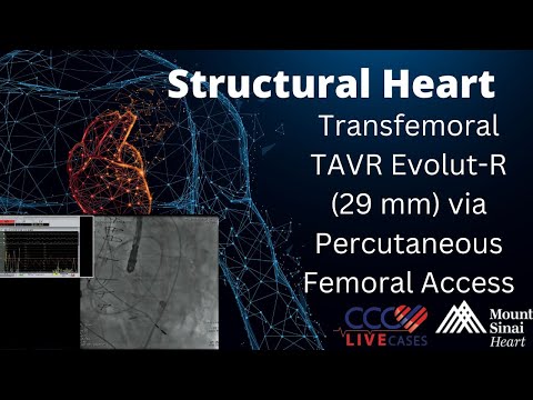 SAPIEN 3 TAVR (26mm) via Percutaneous Femoral Access - Structural Live Jan 2017