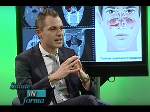 Frattura tuberosità dellarticolazione della spalla con una separazione e spostamento Osteocondrosi delle articolazioni della spalla