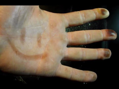 Removing Silver Nitrate Stains
