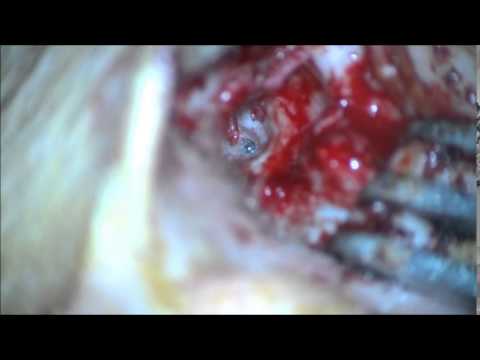 stapedectomy - facial nerve variation