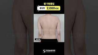 이 정도면 다른 팔 아님? 팔 지방흡입 전후 👀