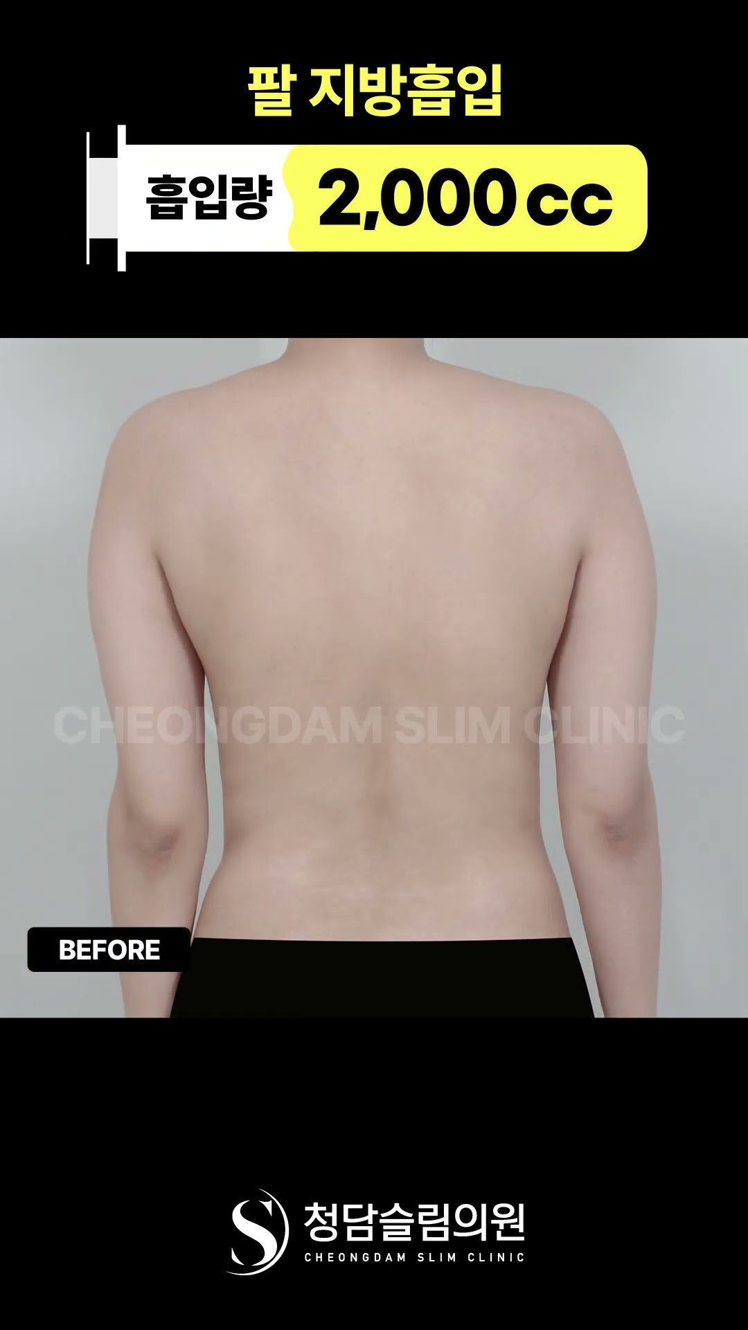 이 정도면 다른 팔 아님? 팔 지방흡입 전후 👀