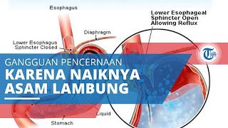 GERD atau Gastroesophageal reflux disease, Gangguan Pencernaan karena Naiknya Asam Lambung