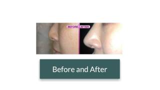 preview picture of video 'Rhinoplasty Northern Va Rhinoplasty Northern Virginia'
