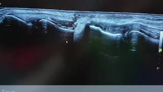 Caso Clínico: Rotura parcial del tendón extensor común jugador de pádel