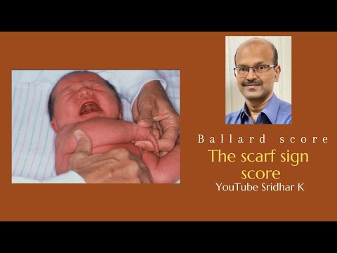 Scarf sign as part of Ballard score assessment. Dr Sridhar K