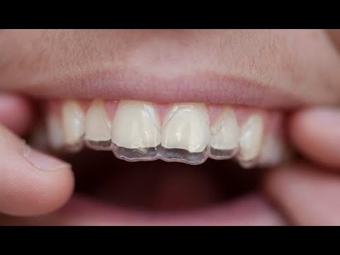 Nëse dikush që ka ndërruar jetë i ka dhëmbët të vendosura me transplant, a duhet tia heqim?