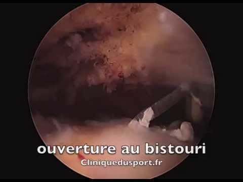 comment soulager calcification épaule