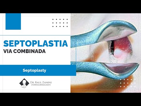 Miniatura: Septoplastia