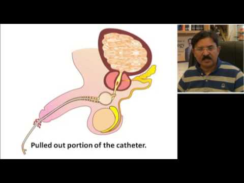 Problems Anytime After Urethral Catheterization