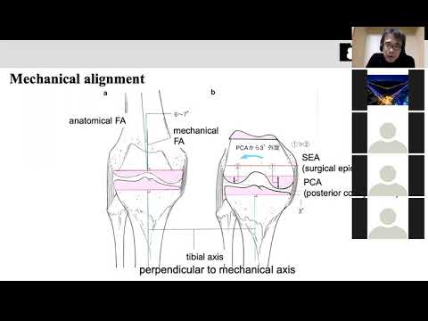 [Lecture by Dr. Hiranaka] Basics of Knee Arthroplasty.
