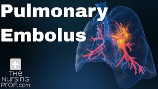 Pulmonary Embolus Nursing Care