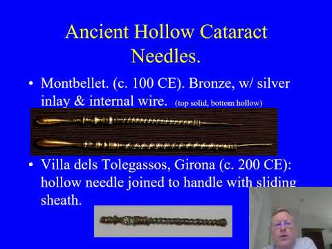 Ancient & medieval cataract surgery: the Susruta Samhita described couching, not extraction.