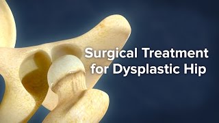 Surgical Treatment for Dysplastic Hip | Cincinnati Children&#39;s