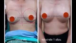 เสริมหน้าอกผ่านทางฐานนม ด้วยเทคนิค Dual  Plane