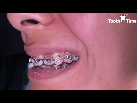 Braces checkups - ZingO string/crimp stop/rotation wedge - Tooth Time Family Dentistry New Braunfels