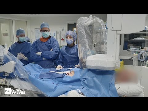 Exceptional engineering, predictable outcomes - Latest development of the VitaFlow TAVI device