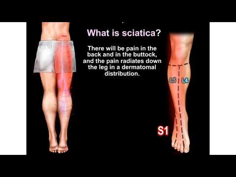 Czy Twoja rwa kulszowa to naprawdę problem z dyskiem czy zespół mięśnia gruszkowatego? Jak to leczyć?