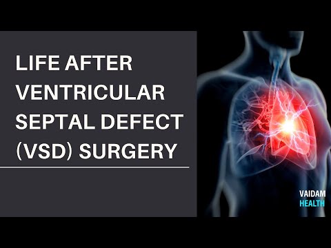 Life after Ventricular Septal Defect VSD Surgery