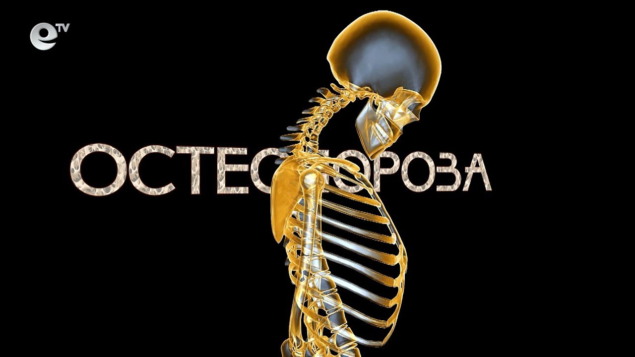 Остеопорозата - тихият убиец