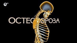 Остеопорозата - тихият убиец