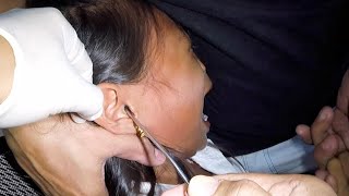 Removing Something Trapped in Girls Ear  Its STUCK
