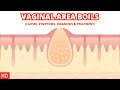 Dealing With Vaginal Area Boils Tips And Advice For Fast Relief