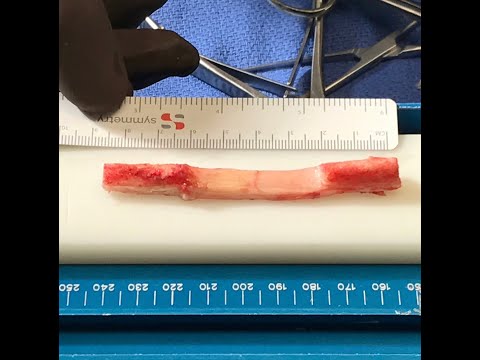 ACL Reconstruction - BTB Autograft Technique Explained