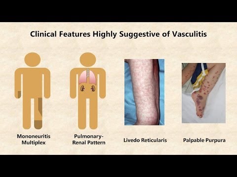 Vasculitis és paraziták