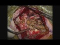 Occiptal Neuralgia Surgery