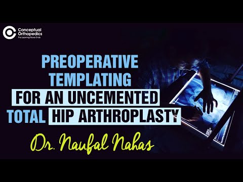 Preoperative Templating in an Uncemented Total Hip Arthroplasty by Dr. Naufal Nahas