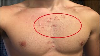 how to get rid of chest acne scars fast