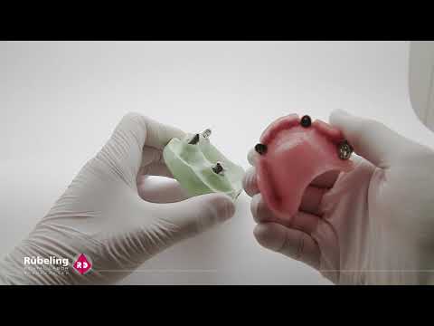 Ein- und ausgliedern einer Teleskopprothese