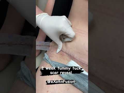 2 week tummy tuck scar reveal