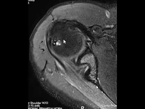 Internal Impingement Shoulder