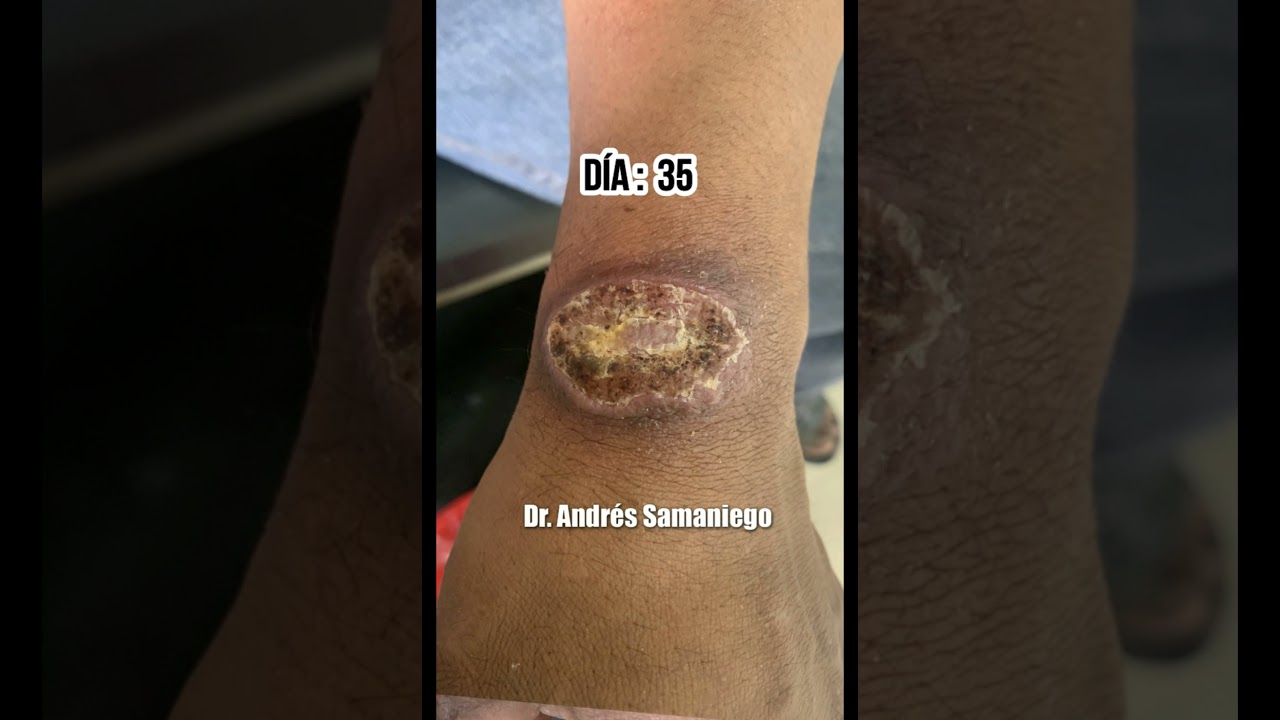 Úlcera | Recuperación & Curación | Leishmaniasis (Dr. Andrés Samaniego) #shorts #timelapse #medicine