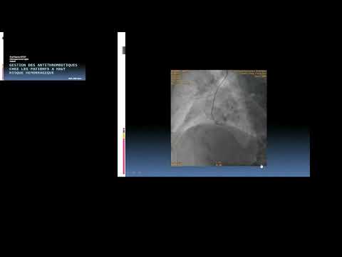 Gestion des antithrombotiques chez des patients à haut risque hémorragique