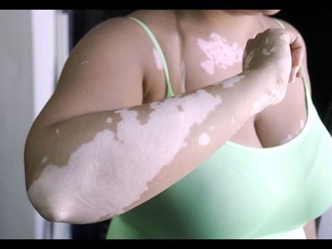 Wie im Krankenhaus bei der Schuppenflechte behandeln Dermasol von der Schuppenflechte