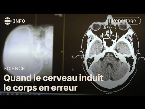 Functional Neurological Disorder: When the Brain Goes Off the Rails | Discovery