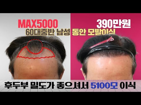 모발이식 60대 중반 MAX5000 절개식 390만원 후두부 밀도가 좋으셔서 5100 동안모발이식