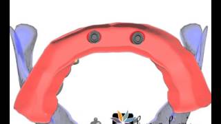 Overdenture com O'rings