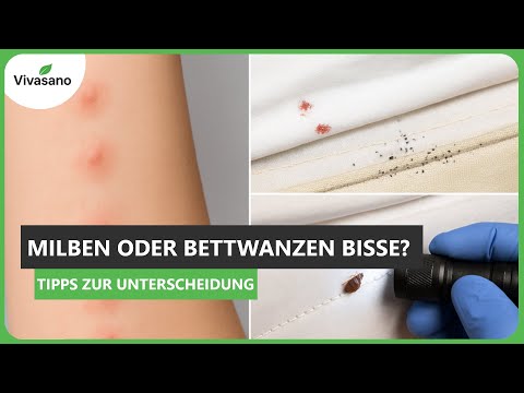 Mite or bed bug bites?