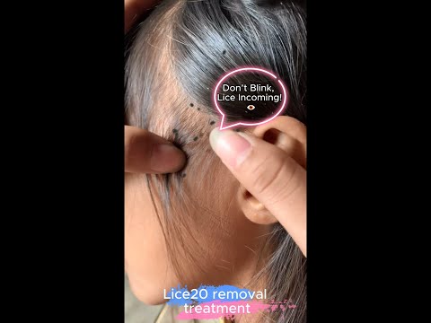 (Part 08) Lice Removal & Treatment  Satisfying Lice Popping
