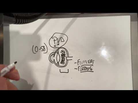 Posterior Vitreous Detachment - PVD: Patient Educational Video